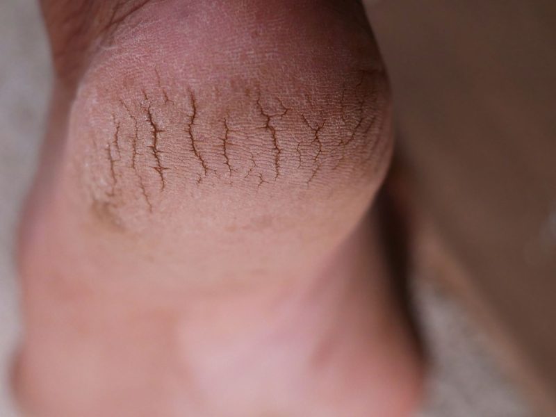 Actionable Tips to Prevent & Get Rid of Skin Cracking Problem Skin cracking is a common issue that can affect anyone, especially during colder months when the air becomes dry and unforgiving. While cracked skin is often associated with hands and feet, it can appear anywhere on the body and can range from mildly uncomfortable to downright painful. The good news? With the right approach, you can both prevent and treat skin cracking effectively. Let’s dive into actionable tips that are easy to follow and guaranteed to help you maintain smooth, healthy skin.