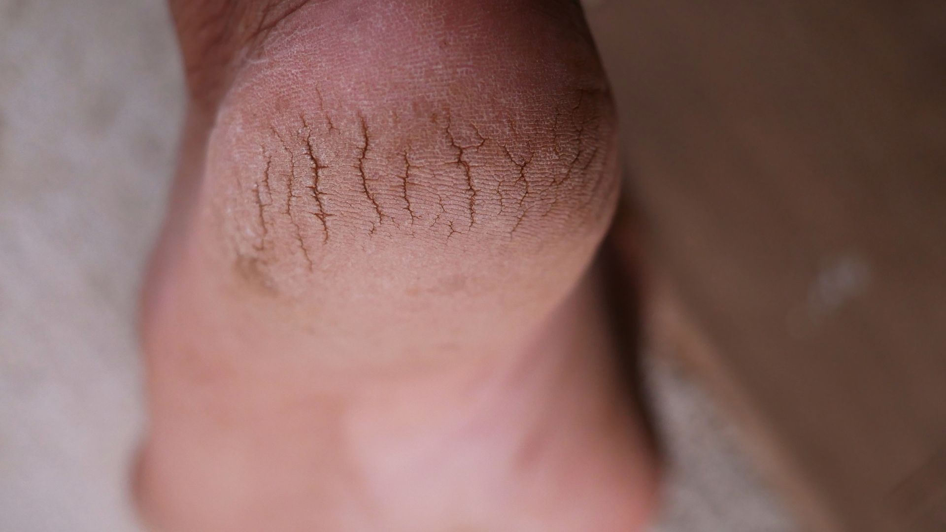 Actionable Tips to Prevent & Get Rid of Skin Cracking Problem Skin cracking is a common issue that can affect anyone, especially during colder months when the air becomes dry and unforgiving. While cracked skin is often associated with hands and feet, it can appear anywhere on the body and can range from mildly uncomfortable to downright painful. The good news? With the right approach, you can both prevent and treat skin cracking effectively. Let’s dive into actionable tips that are easy to follow and guaranteed to help you maintain smooth, healthy skin.