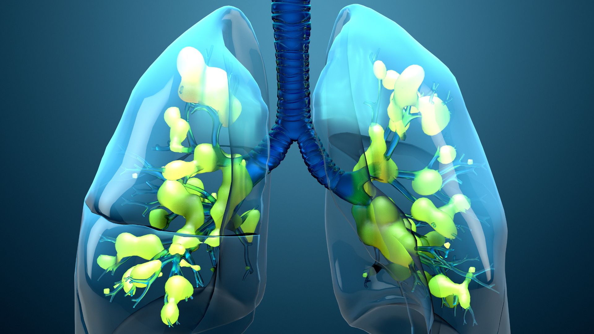 How Deadly is Pneumonia