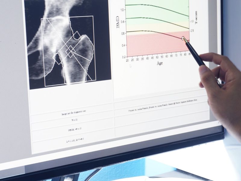 Low Bone Density