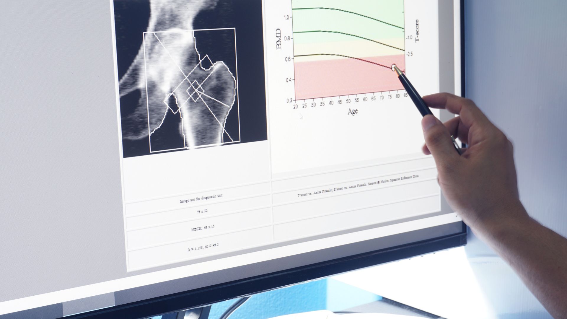 Low Bone Density