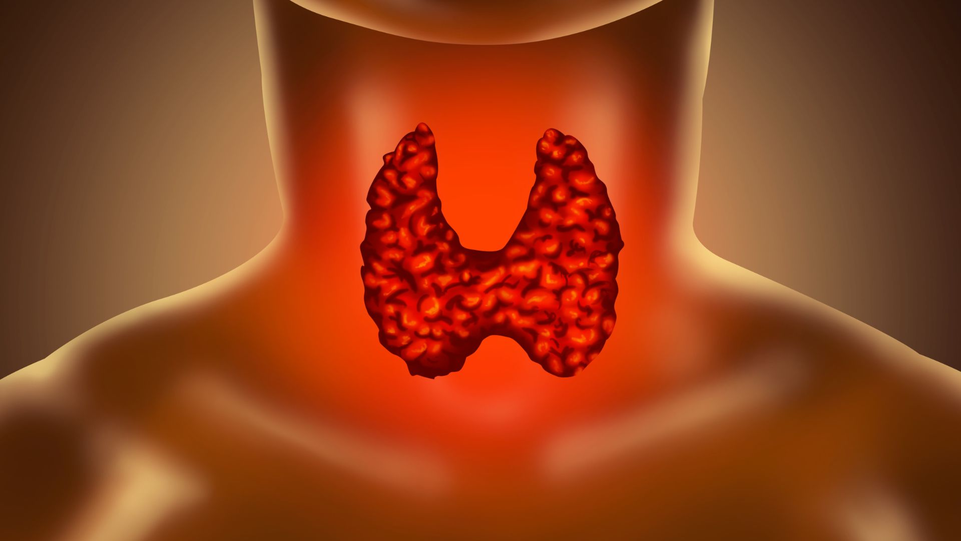 Illustration of the human neck showing an enlarged thyroid gland highlighted in red